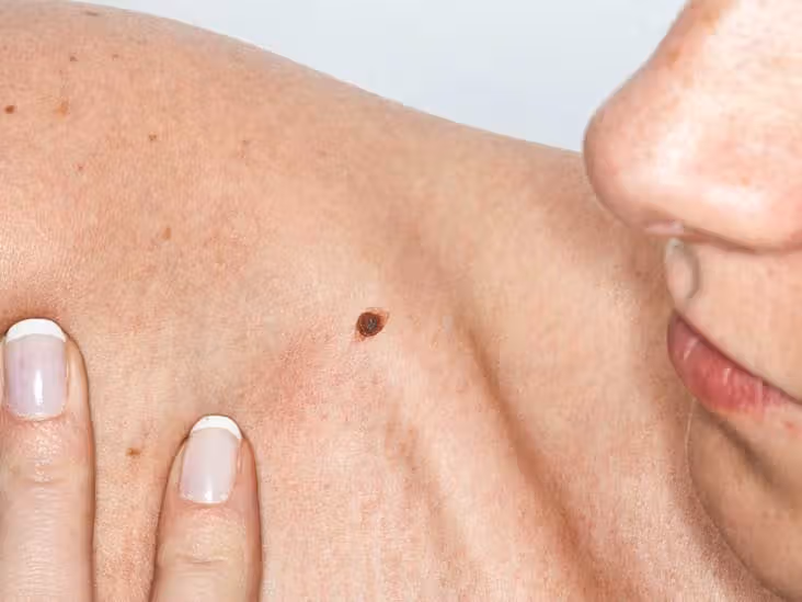 Skin cancer spots article